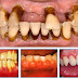 Các triệu chứng viêm chân răng người bệnh cần biết