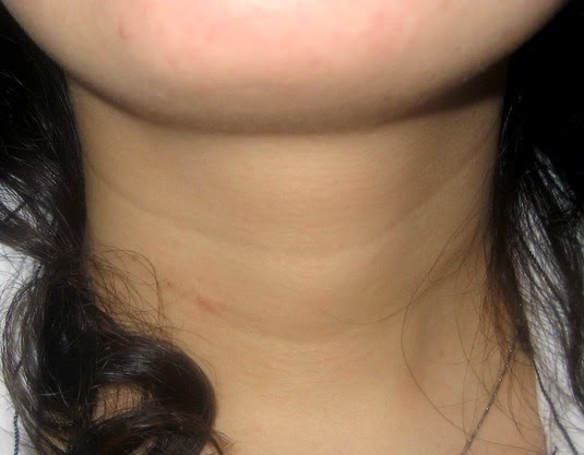 wrinkles thyroid facial Deep