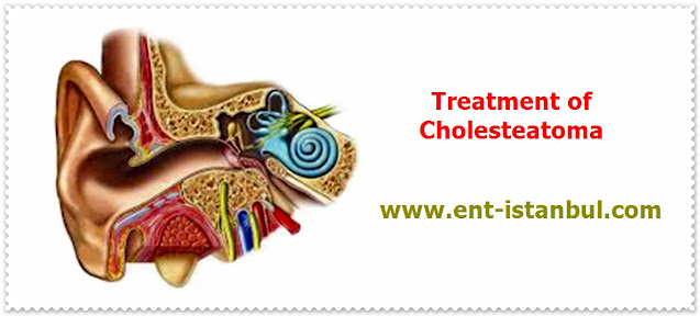Cholesteatoma Treatment