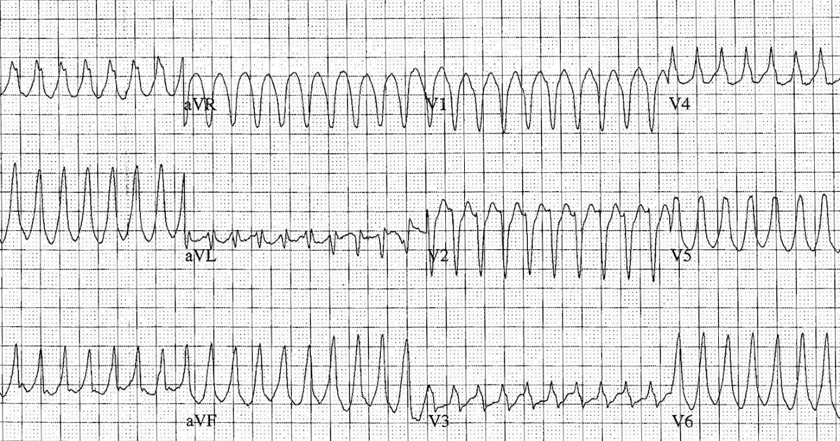 ECG of the Week: ECG of the Week - 7th May 2012 - Interpretation