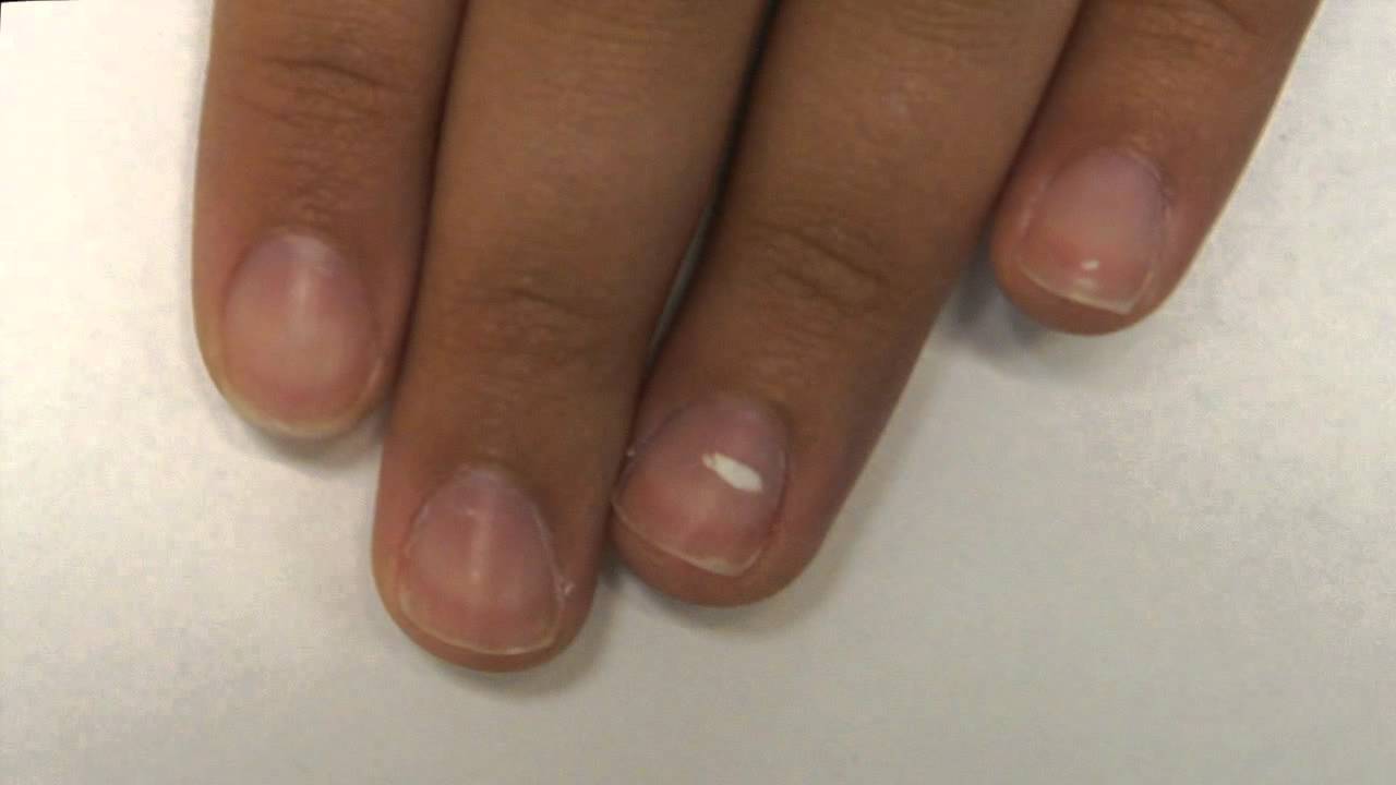 What Do White Vertical Lines On Nails Mean - Design Talk