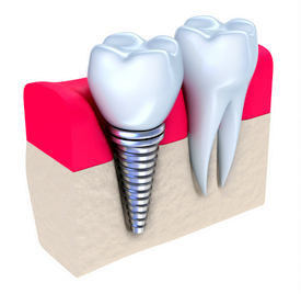 Dental Implants image