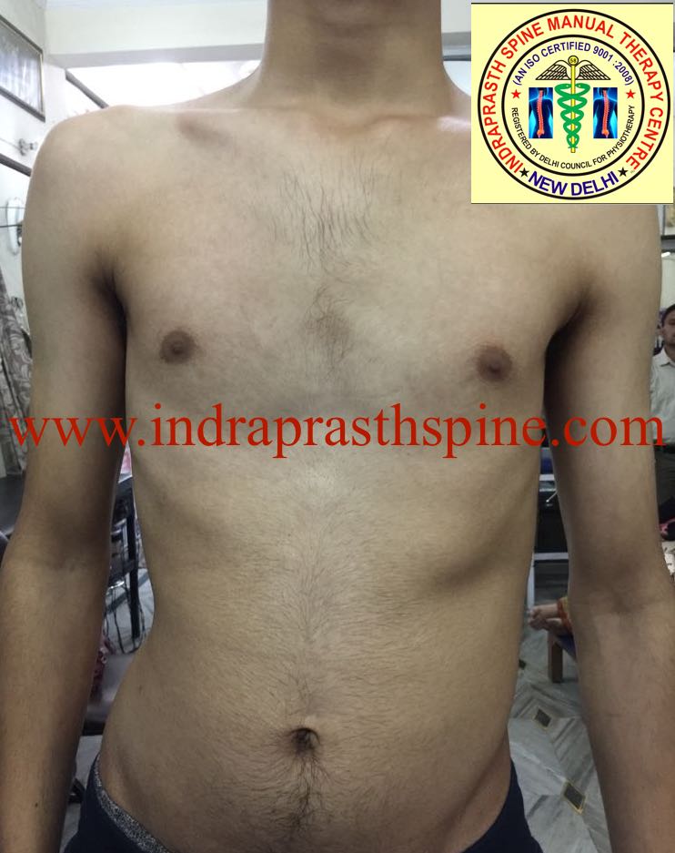 INDRAPRASTH PHYSIOTHERAPY CENTRE PIGEON CHEST (PECTUS CARINATUM)