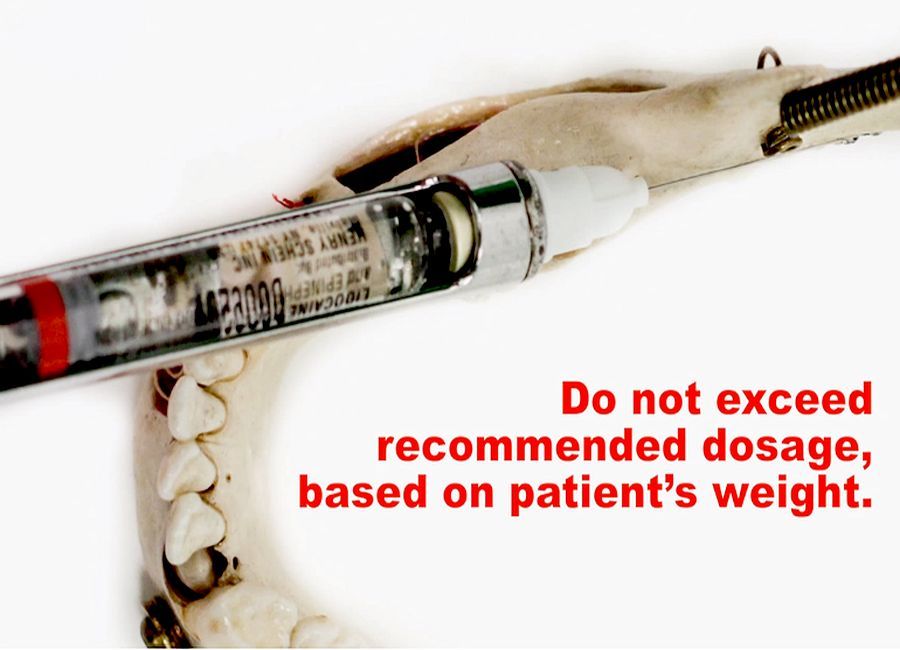 DENTAL ANESTHESIA Children's Dental Injection Technique (Mandibular Block for Pediatric