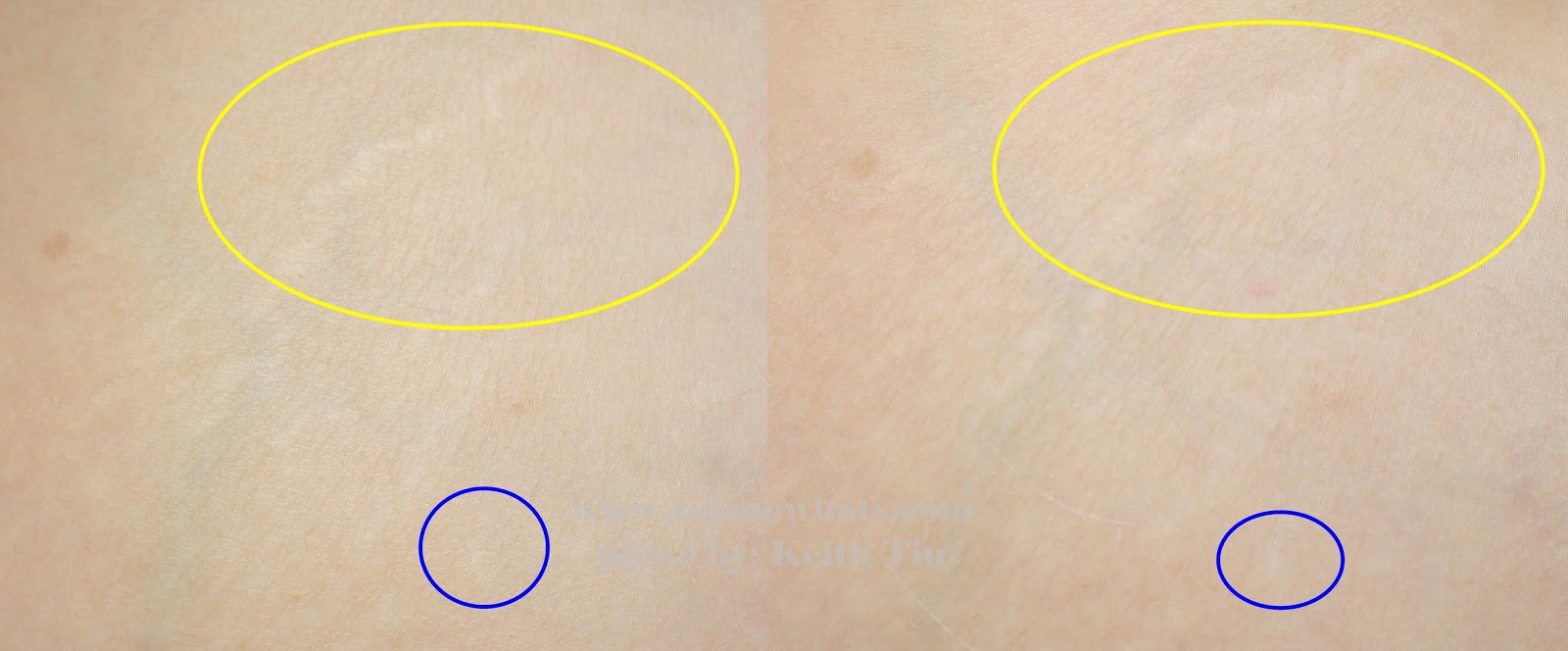 gly derm stretch mark