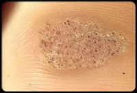 corn on foot with black center