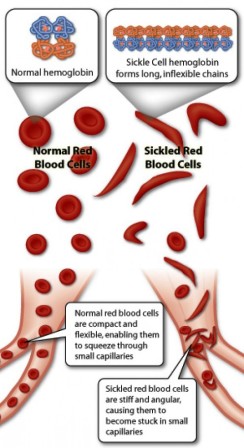 lethal sickle anemia genes