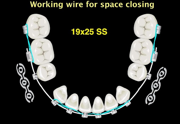 DIGITAL ORTHODONTICS: My perspective - Arch Wires and Archform (Part 3)
