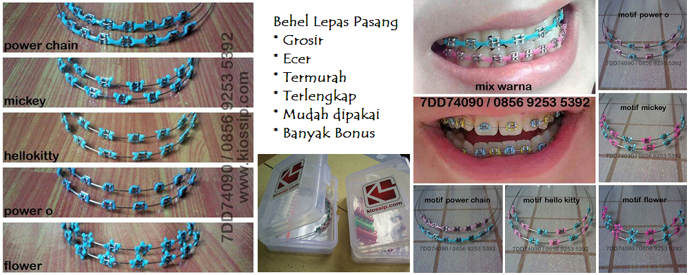 Cara Pakai Behel Lepas Pasang Informasi Dunia Kesehatan Cara Pakai Behel Lepas Pasang Informasi Dunia Kesehatan