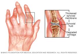 ízületi fájdalom rheumatoid arthritisben