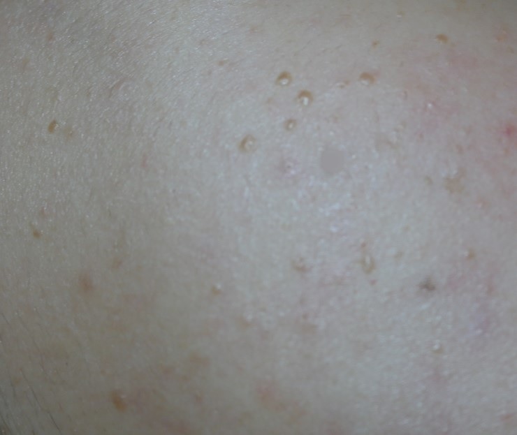 Irene dematology story the contagious of flat wart(verruca plana) By CNP SKIN LASER CLINIC