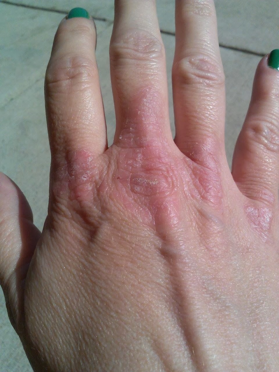 Sausage toes and scales. Living life with Psoriatic Arthritis Cimzia