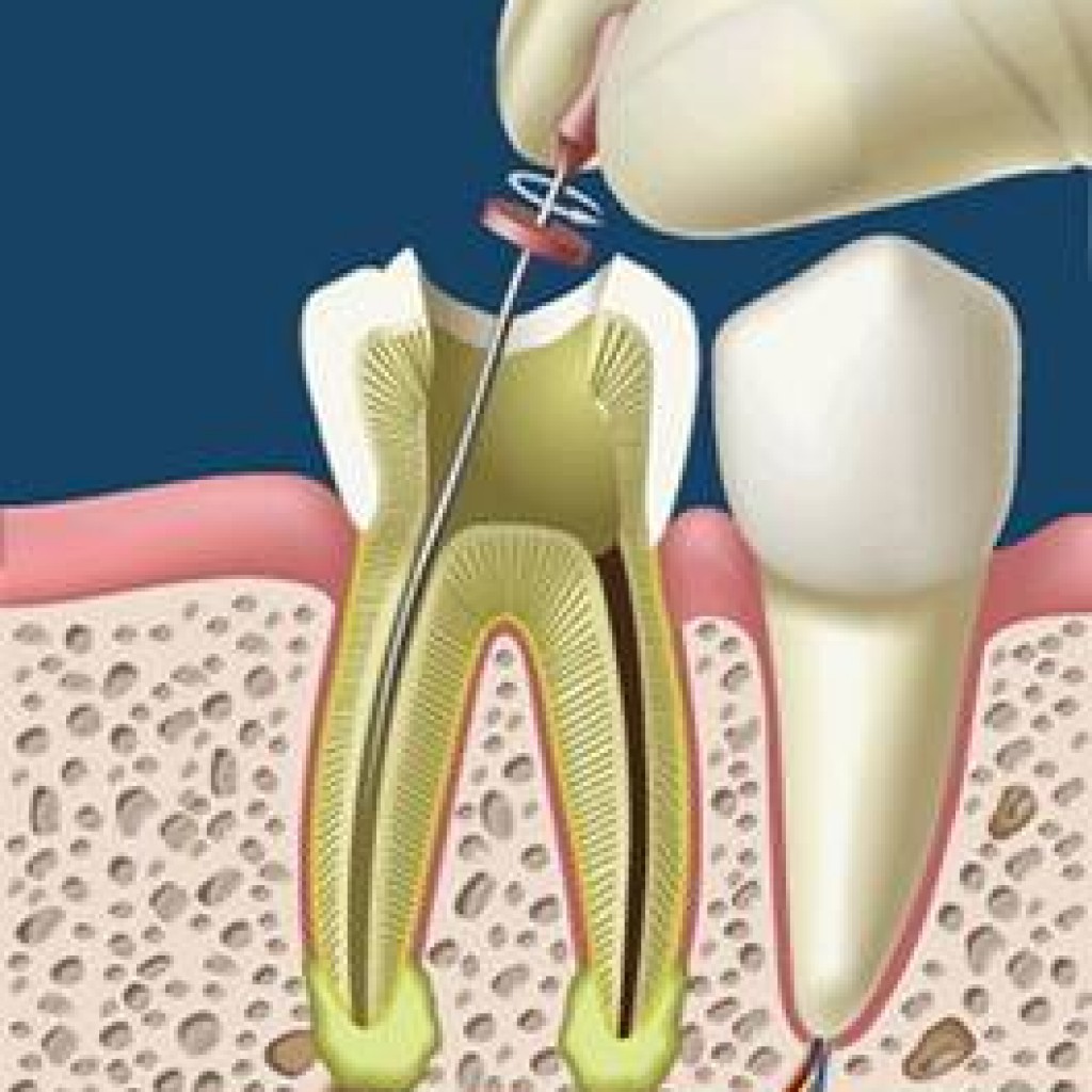 Centro Odontológico Dr. Vargas ¿QUE ES UN TRATAMIENTO DE ENDODONCIA? Centro Odontológico Dr. Vargas ¿QUE ES UN TRATAMIENTO DE ENDODONCIA?