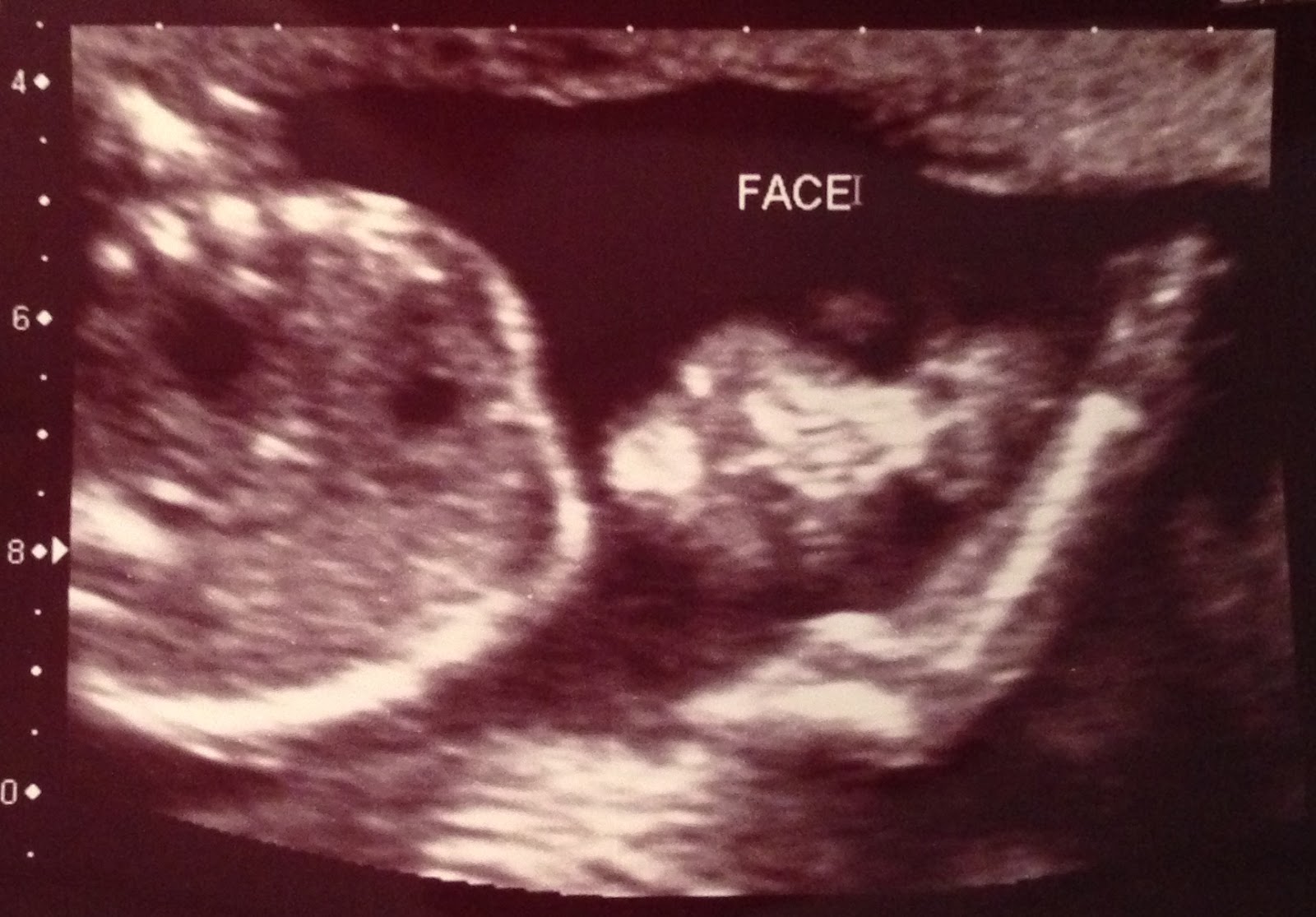 How to Make a Smile Baby Girl 20 week ultrasound