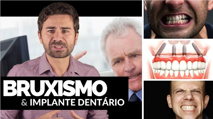 IMPLANTODONTIA: Quem tem Bruxismo Pode Fazer Implantes Dentários? - Fernando Giovanella