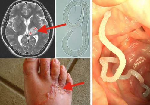 Here's How To Kill All The Parasites In Your Body Quickly And Easily