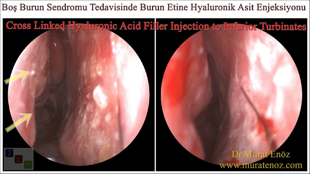 Boş burun sendromu tanımı - Boş burun sendromu belirtileri - Boş burun sendromu tedavisi - Boş burun sendromu tedavisinde Hyaluronik Asit dolgusu - Burun eti dolgusu - Treatment of Empty nose syndrome with hyaluronic acid filler - Boş burun - Geniş burun boşluğu sendromu - Burun eti büyütülmesi - Empty Nose Syndrome (ENS)