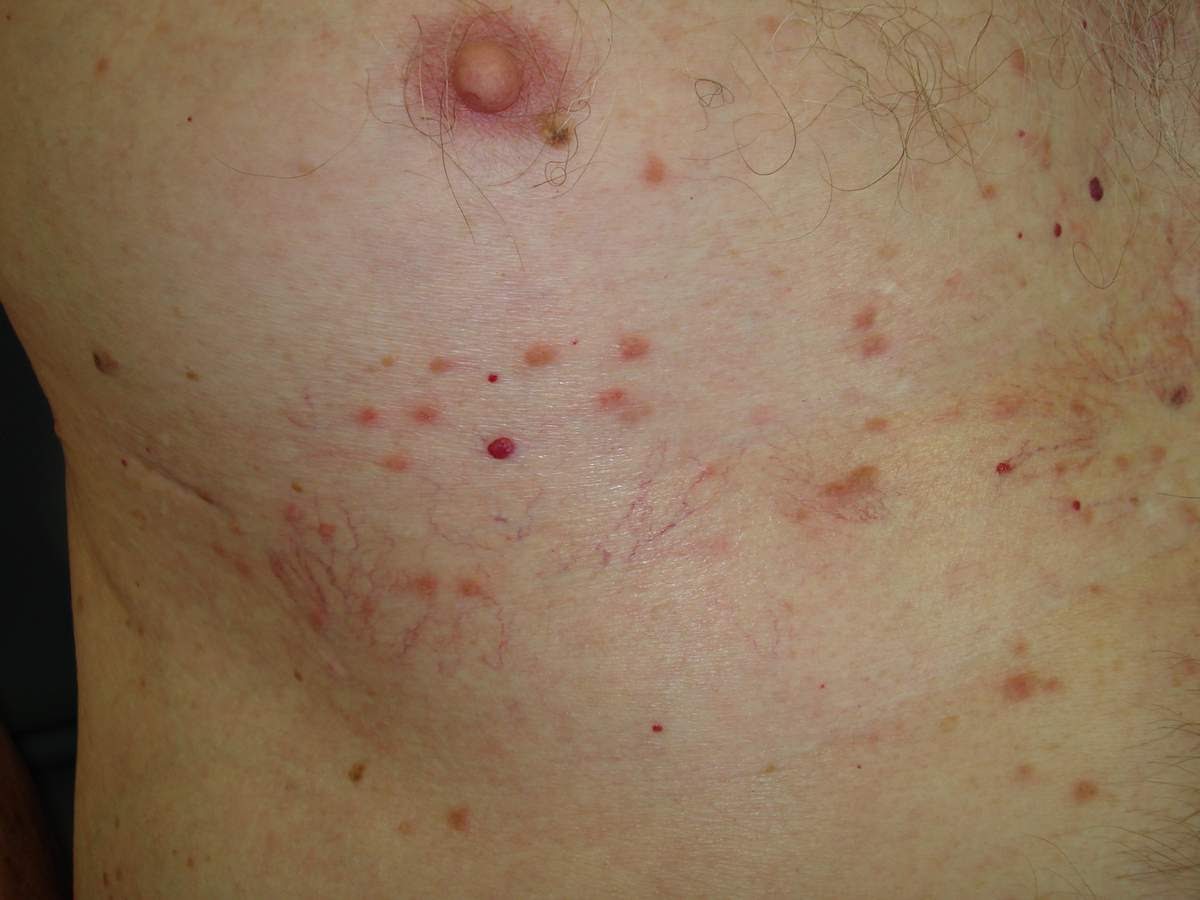 Grover's disease - Features, Diagnosis, and Treatment ...