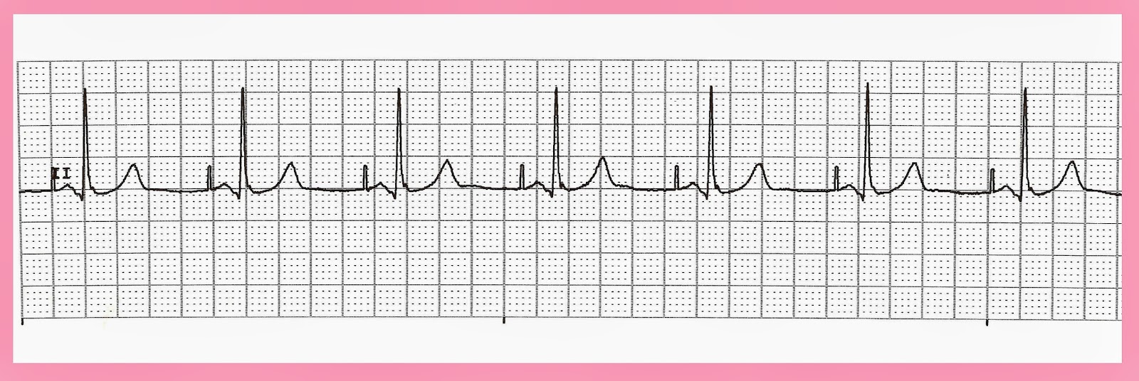 Various Atrial Paced Rhythms