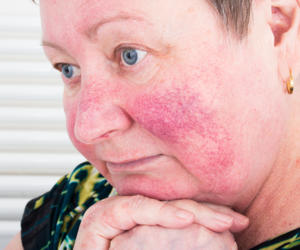 Imagenes de rosacea en el rostro