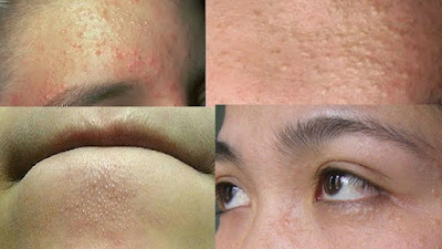 Dùng Serum Kiều bị nổi mụn Dùng Serum Kiều bị nổi mụn