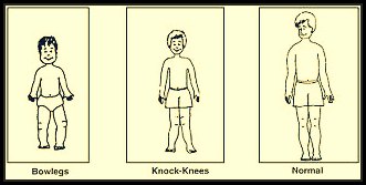 How to Check Knock Knees for Indian Army SSB?_40.1