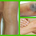 Lighten Dark Knees, Elbows And Remove Old Scars Quick And Naturally At Home