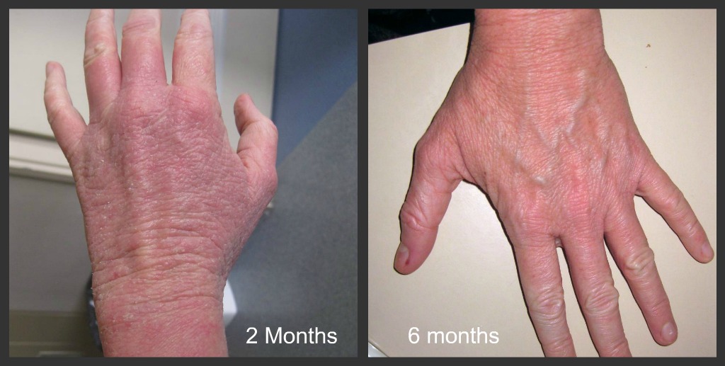 Red Skin Syndrome Treatment Options