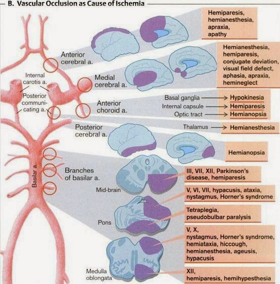 HOW ISCHEMIA AFFECTS DIFFERENT PARTS OF THE BODY visual data 2