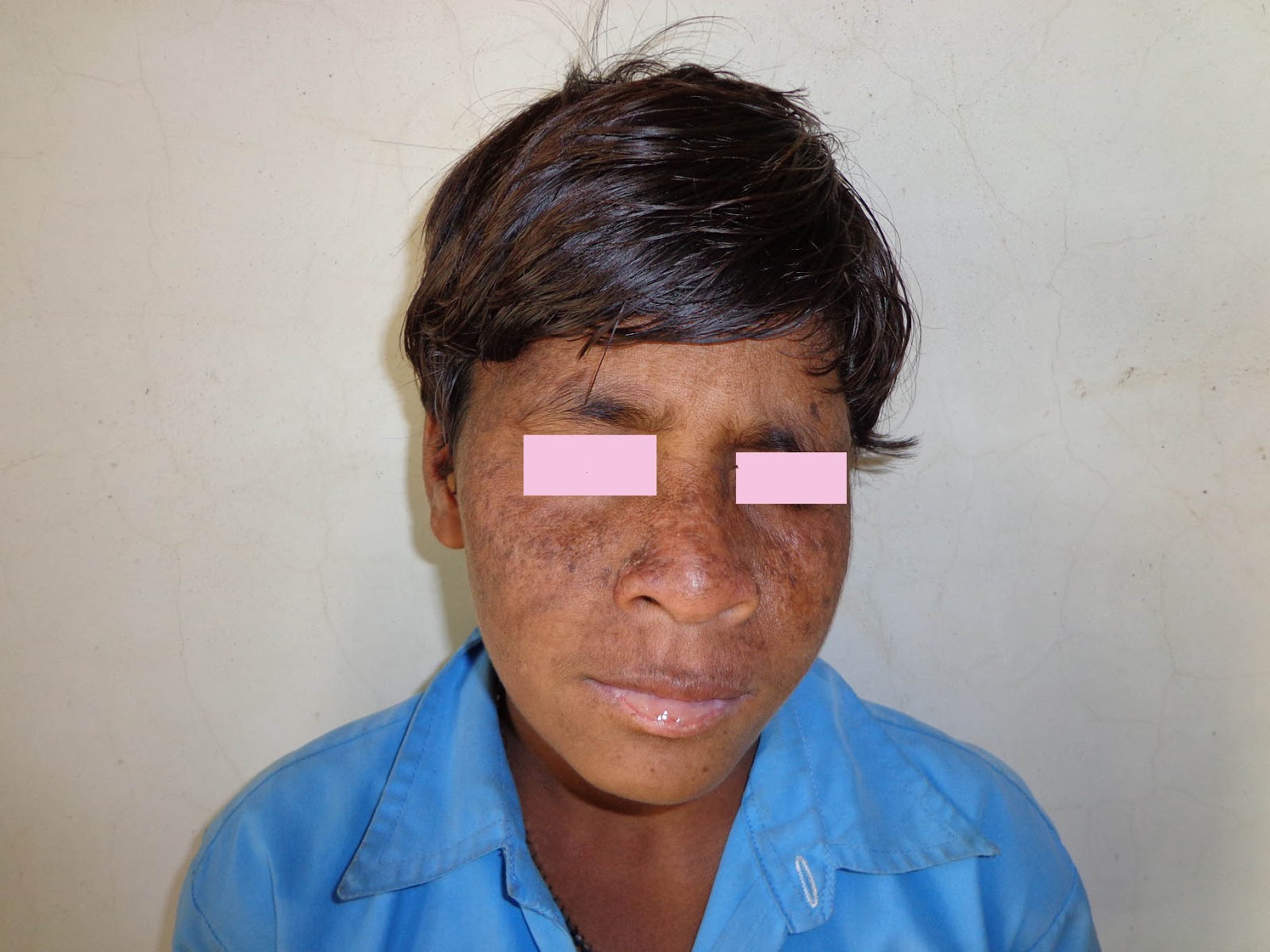 VIRTUAL GRAND ROUNDS IN DERMATOLOGY 2.0: Scald-like Eruption in a Newborn