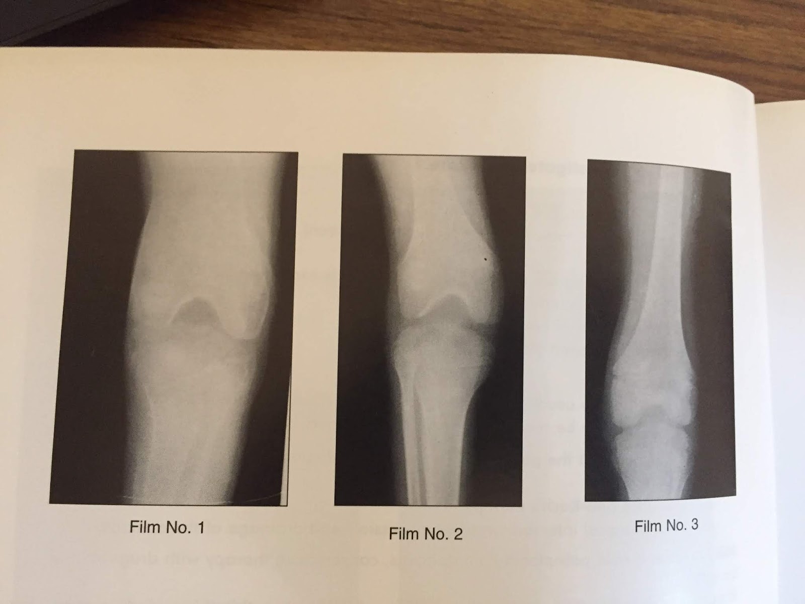 XRAYS OF HEMOPHILIC ARTHRITIS