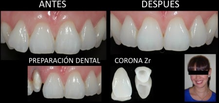 Corona dental antes y despues de adelgazar