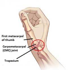 CMC-Joint-1-_100_large.jpg