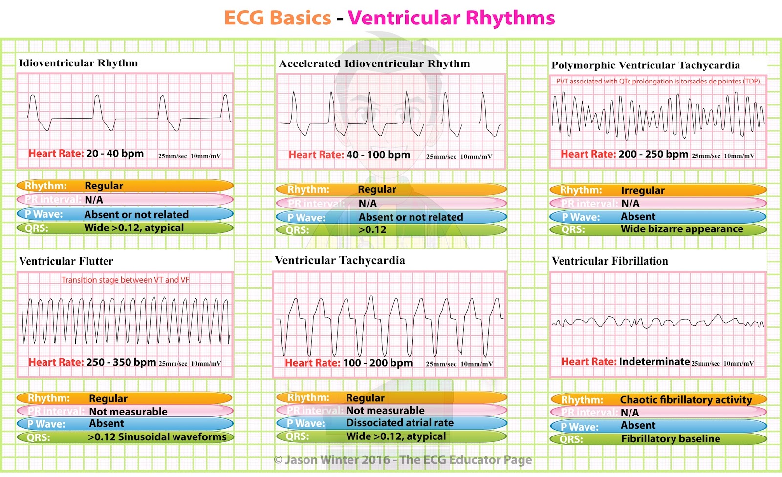 Printable Ekg Rhythms Printable Blank World Printable Ekg Rhythms Printable Blank World
