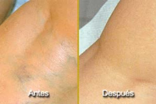 Como quitar las varices rapido