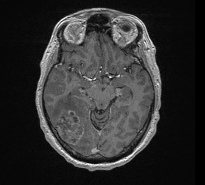 brain-tumor-cancer-mr-imaging-of-the-brain-radtechonduty