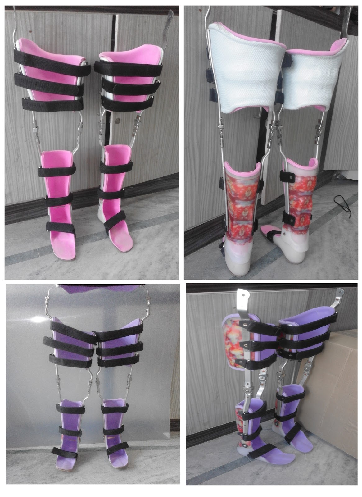 Custom Polio Brace (Knee Ankle Foot Orthosis)