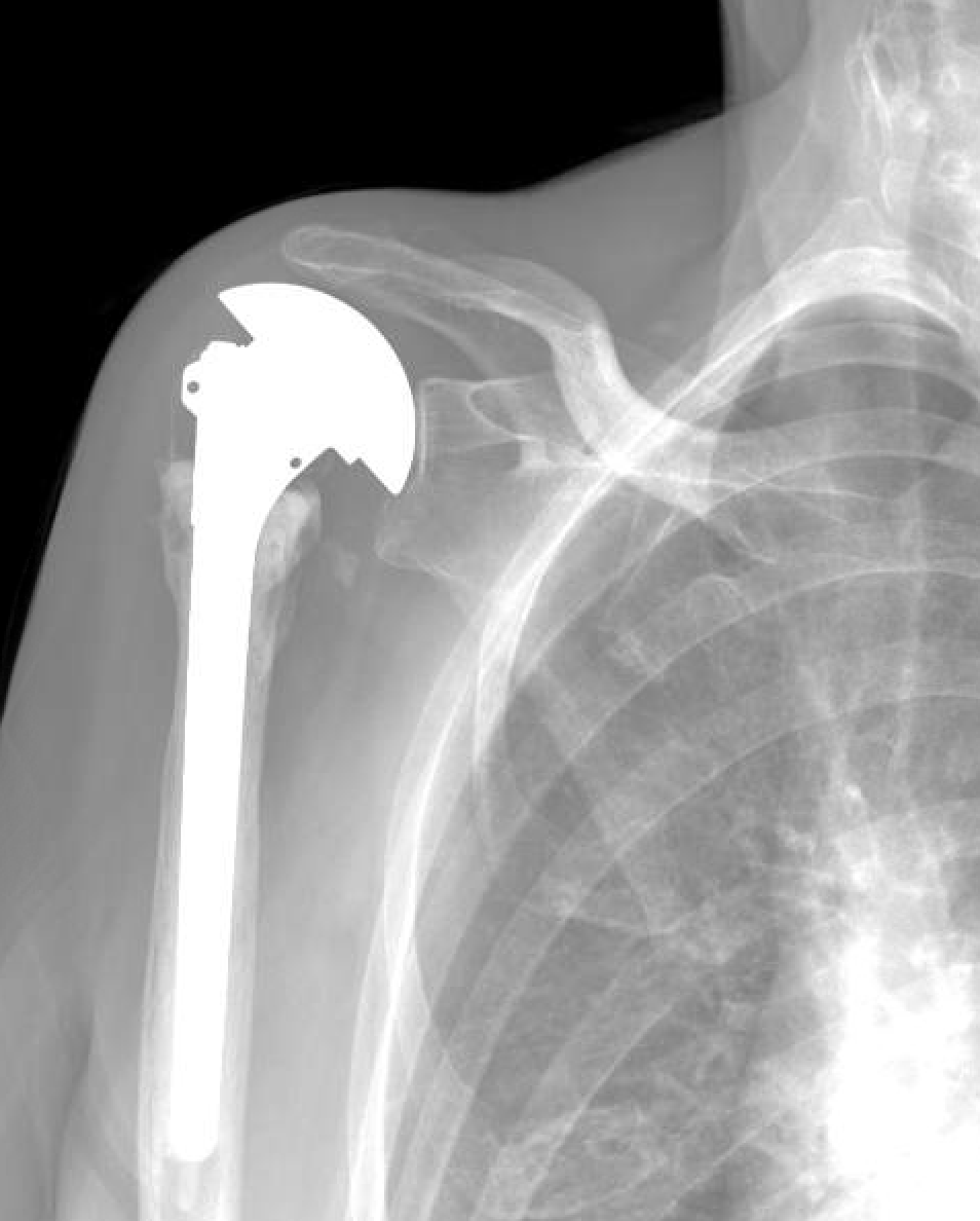 Shoulder and Elbow Surgery Revision of failed cemented
