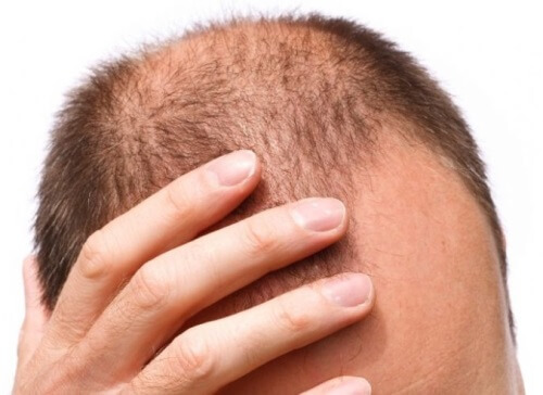 hair loss in men