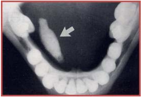 重新載圖下圖所示之x光影像 題組 78 承上題 圖中之x光影像 箭頭所示處 最可 阿摩線上測驗