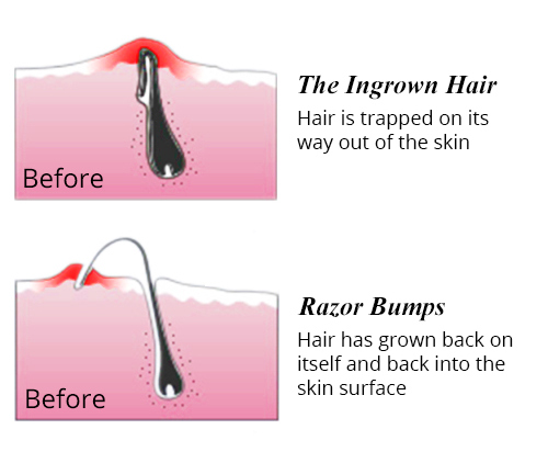 Wondering how to get rid of ingrown hairs and prevent them? 