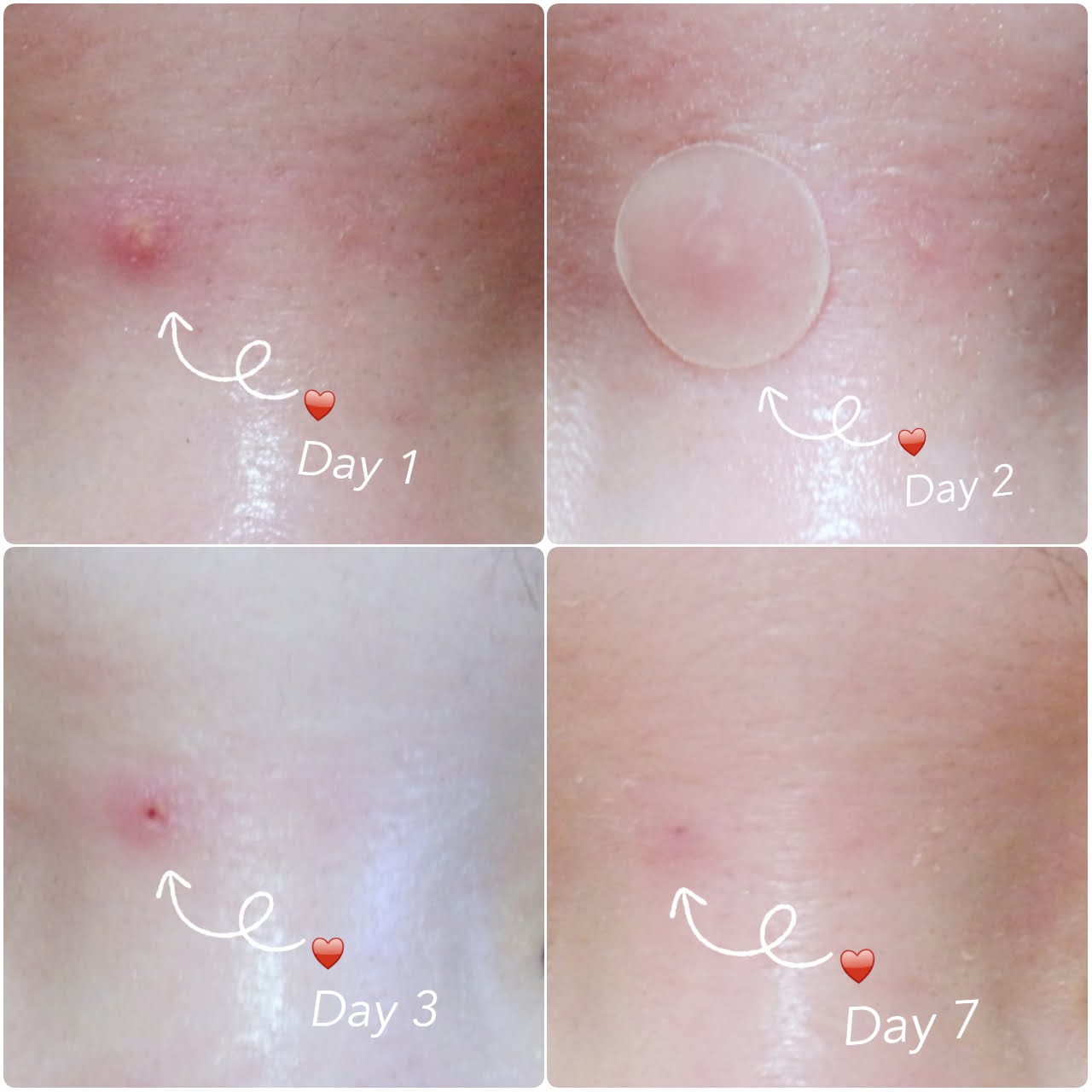 REVIEW(S) Cosrx Acne Pimple Master Patch pinkislovebynix