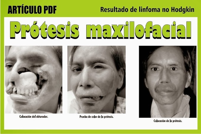 PDF: Prótesis maxilofacial en defecto intraoral y extraoral resultado de linfoma no Hodgkin