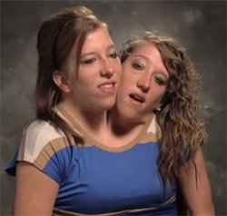 Conjoined Twins, Abby and Brittany on TLC