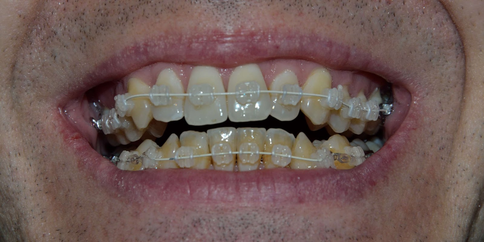 The View From My Soapbox Orthodontic treatment first adjustment