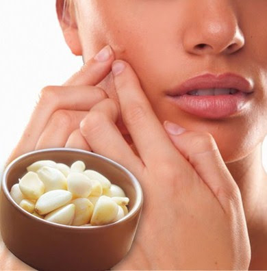 Tips Mengatasi Jerawat Batu Secara Alami Dan Permanen