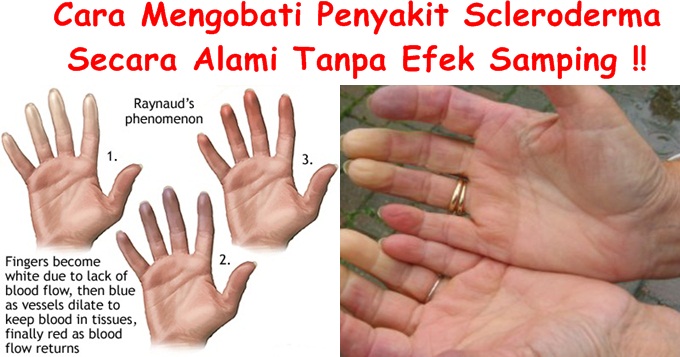 Obat Tradisional Scleroderma