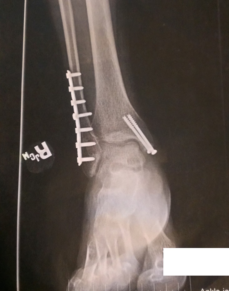 how-long-does-it-take-for-a-broken-ankle-to-heal