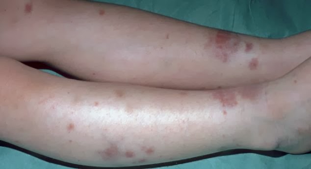 Red Blotches Lower Leg - Doctor insights on HealthTap