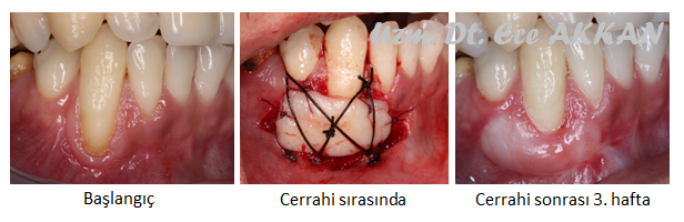 Dişeti Sağlığı ve Hastalıkları Serbest Dişeti Grefti